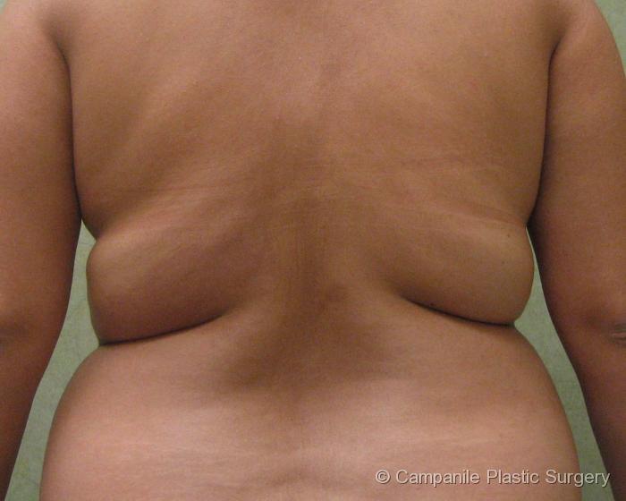 Liposuction Patient Photo - Case 69 - before view-