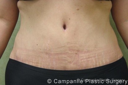 Tummy Tuck Patient Photo - Case 36 - after view