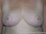 Breast Reduction - Case 173 - After