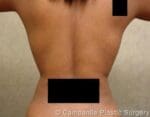 Liposuction - Case 73 - After