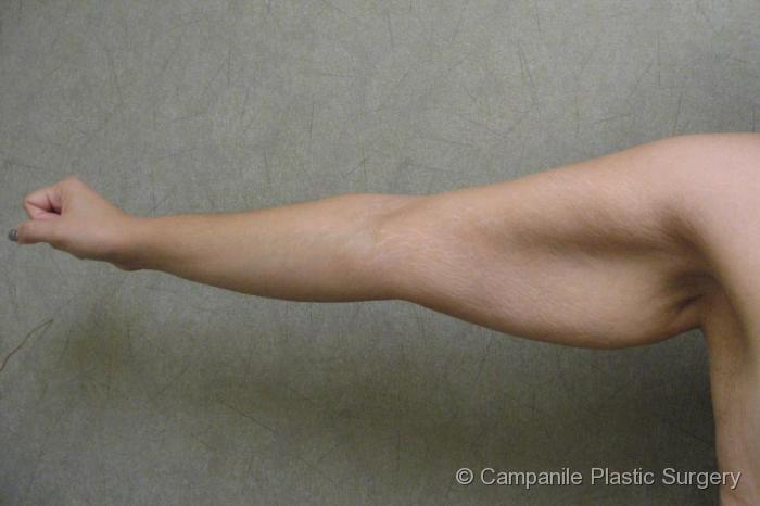 Arm Lift Patient Photo - Case 79 - before view-