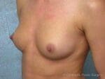 Breast Augmentation - Case 113 - Before