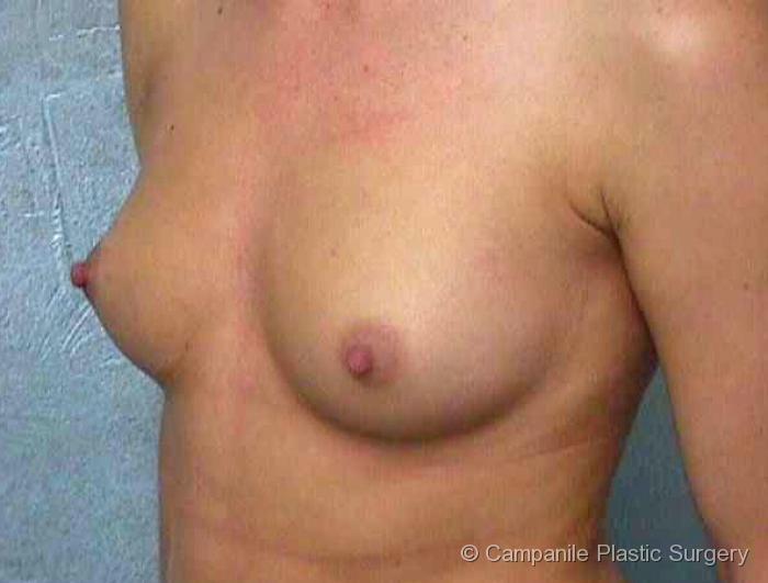 Breast Augmentation Patient Photo - Case 113 - before view-