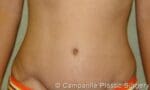 Tummy Tuck - Case 44 - After