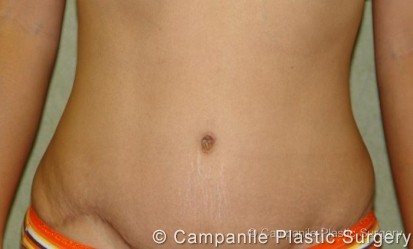 Tummy Tuck Patient Photo - Case 44 - after view