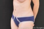 C.L.A.S.S.™ Tummy Tuck - Case 240 - After