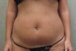 Liposuction - Case 66 - Before