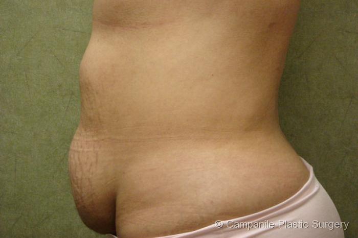 C.L.A.S.S.™ Tummy Tuck Patient Photo - Case 30 - before view-
