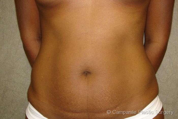 Tummy Tuck Patient Photo - Case 39 - before view-