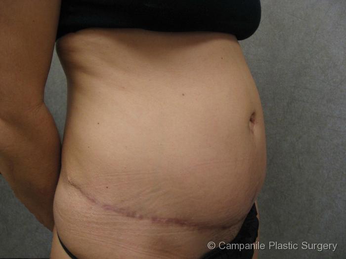 Tummy Tuck Revision Patient Photo - Case 52 - before view-1