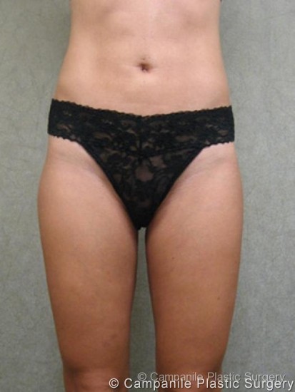 Liposuction Patient Photo - Case 59 - after view-0