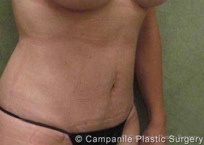 Mini Tummy Tuck Patient Photo - Case 48 - after view
