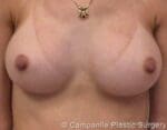 Breast Augmentation - Case 116 - After