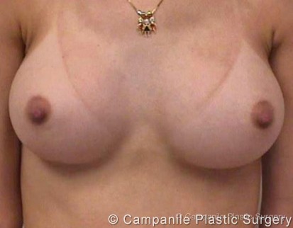 Breast Augmentation Patient Photo - Case 116 - after view