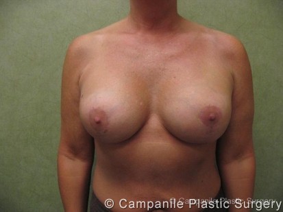 Breast Surgery Revision Patient Photo - Case 181 - after view-1