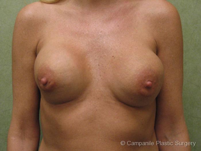 Breast Surgery Revision Patient Photo - Case 186 - before view-