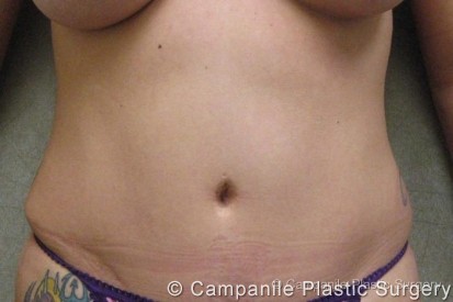 Tummy Tuck Patient Photo - Case 37 - after view