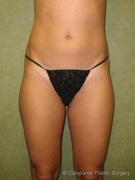 Liposuction Patient Photo - Case 59 - before view-