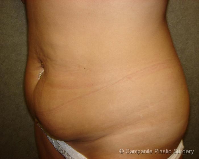 Tummy Tuck Patient Photo - Case 38 - before view-
