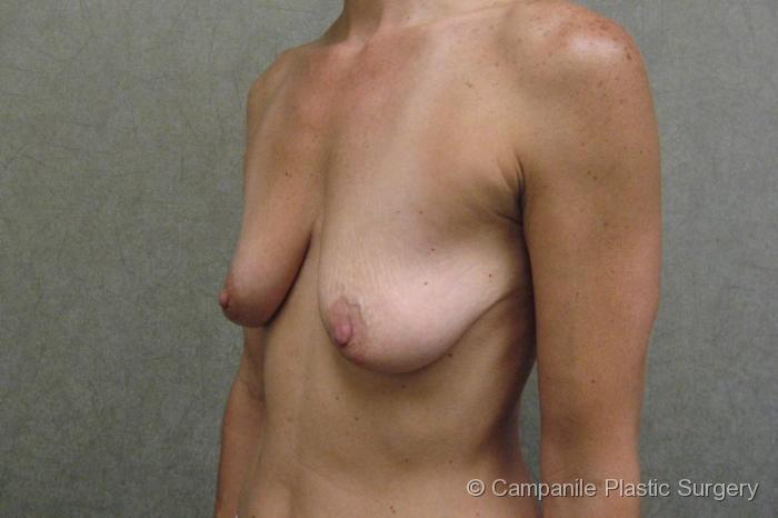 Breast Lift with Augmentation Patient Photo - Case 192 - before view-2
