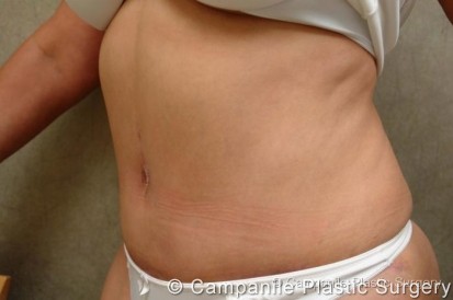 C.L.A.S.S.™ Tummy Tuck Patient Photo - Case 15 - after view