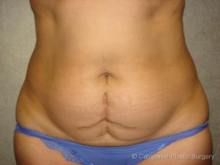 C.L.A.S.S.™ Tummy Tuck Patient Photo - Case 32 - before view-