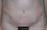 Tummy Tuck - Case 45 - After