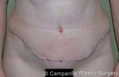 Tummy Tuck Patient Photo - Case 45 - after view