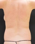 Liposuction - Case 271 - Before