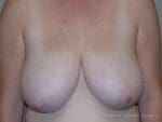 Breast Reduction - Case 173 - Before