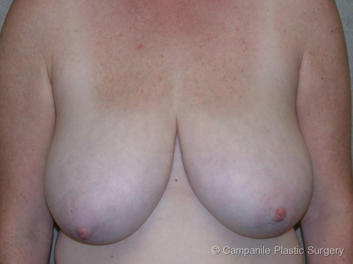 Breast Reduction Patient Photo - Case 173 - before view-