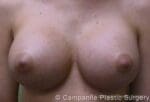 Breast Augmentation - Case 140 - After