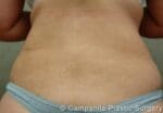 Liposuction - Case 58 - After