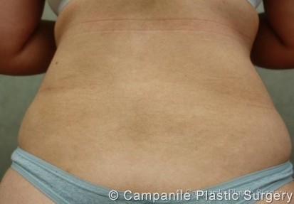 Liposuction Patient Photo - Case 58 - after view