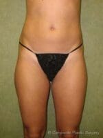 Liposuction - Case 67 - Before