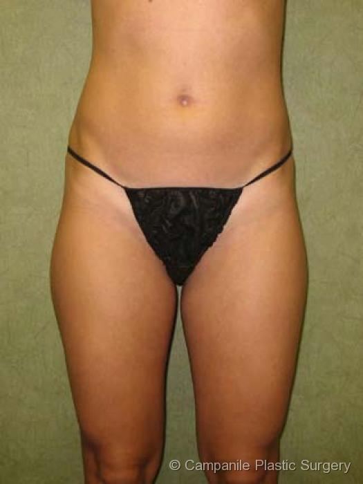 Liposuction Patient Photo - Case 67 - before view-0