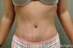 Tummy Tuck - Case 40 - After