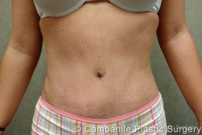 Tummy Tuck Patient Photo - Case 40 - after view
