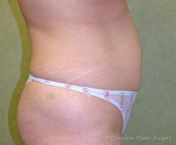 Liposuction Patient Photo - Case 72 - before view-