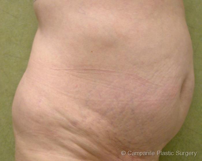 Tummy Tuck Patient Photo - Case 42 - before view-