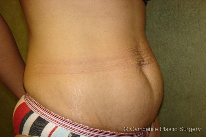 Tummy Tuck Patient Photo - Case 44 - before view-1