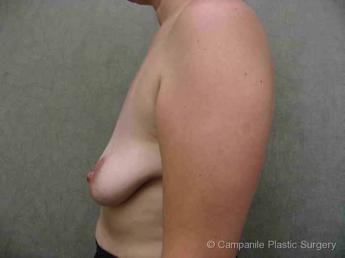 Breast Lift with Augmentation Patient Photo - Case 187 - before view-