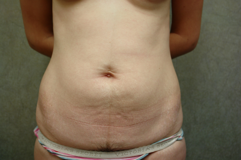 Tummy Tuck Patient Photo - Case 34 - before view-