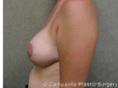 Breast Lift with Augmentation Patient Photo - Case 187 - after view