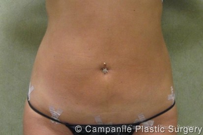 Liposuction Patient Photo - Case 66 - after view