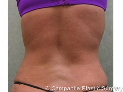 Liposuction Patient Photo - Case 75 - after view