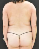 Liposuction - Case 273 - Before