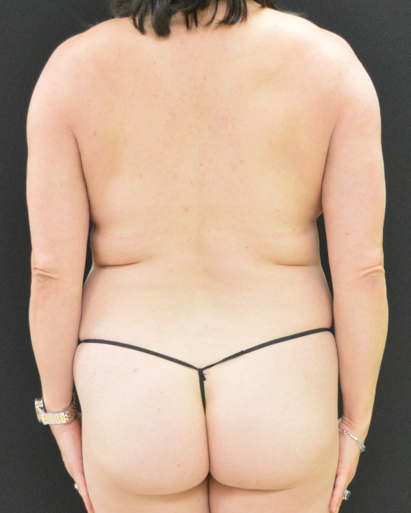 Liposuction Patient Photo - Case 273 - before view-