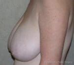 Breast Reduction - Case 161 - Before