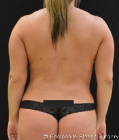 Liposuction Patient Photo - Case 217 - after view